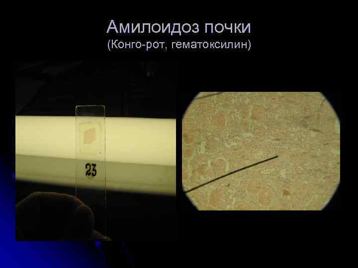 Амилоидоз почки (Конго-рот, гематоксилин) 