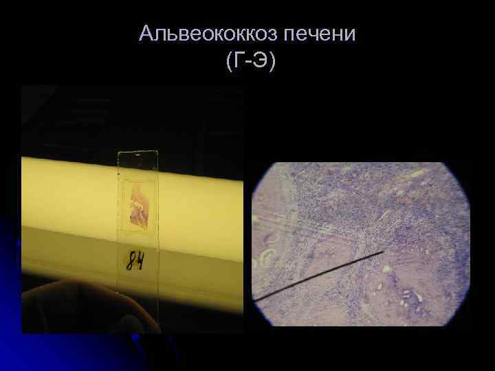 Альвеококкоз печени (Г-Э) 