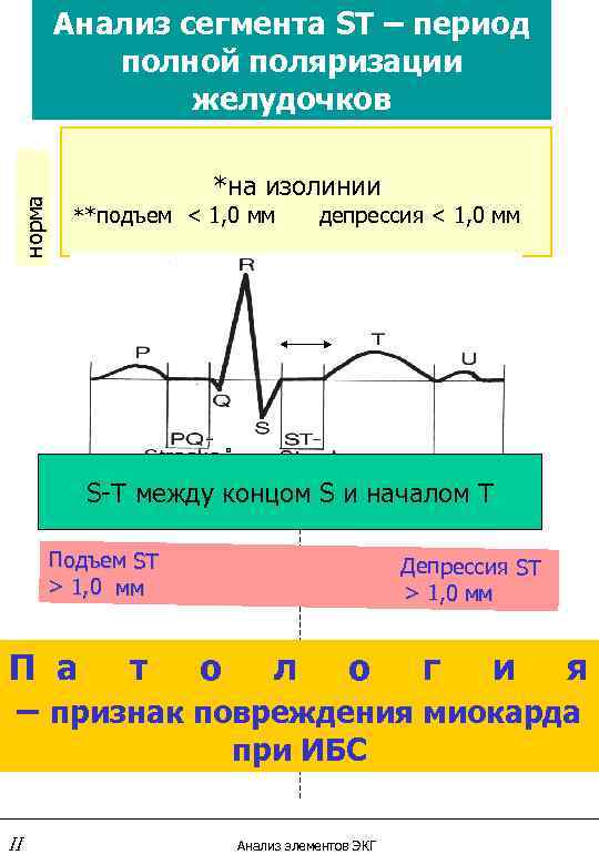 норма Анализ сегмента ST – период полной поляризации желудочков *на изолинии **подъем < 1,