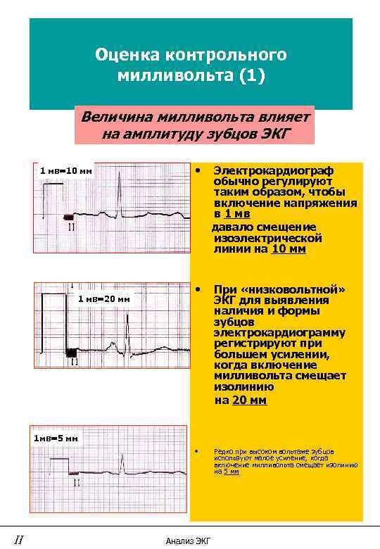 Мм экг. 10мм/МВ 50мм/с ЭКГ фильтр изолинии. Амплитуда зубцов ЭКГ мм/МВ. Амплитуда зубцов при 25 мм ЭКГ. 1 Мм это 1 МВ на ЭКГ.