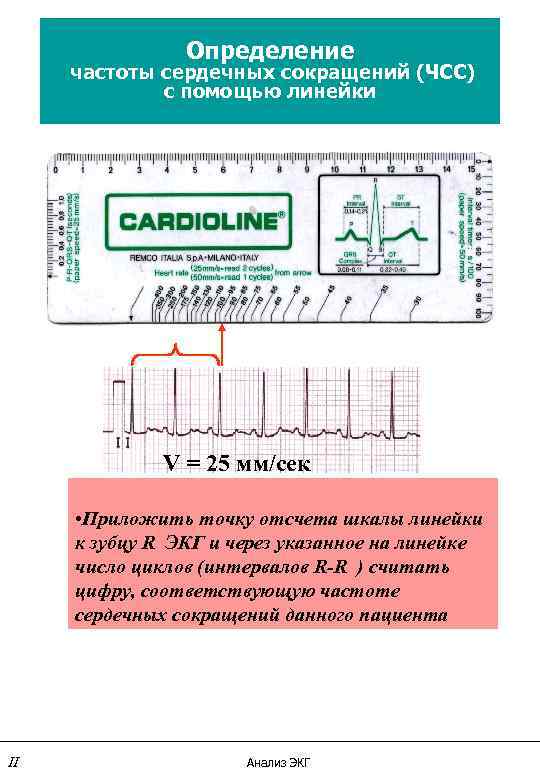 Определение частоты сердечных сокращений (ЧСС) с помощью линейки V = 25 мм/сек • Приложить