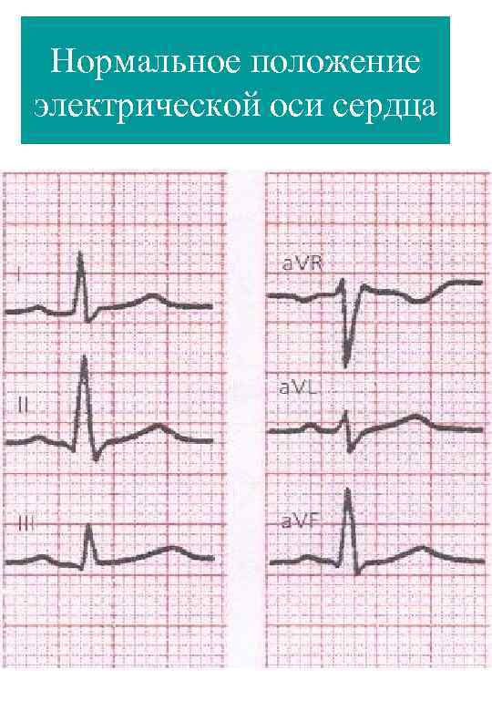 Нормальное положение электрической оси сердца 