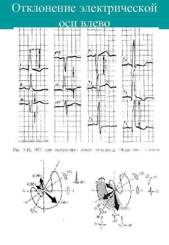 Отклонение электрической оси влево 
