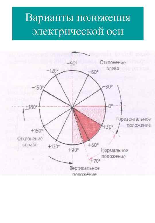 Варианты положения электрической оси 