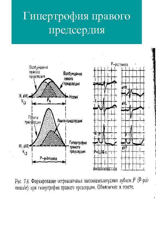 Гипертрофия правого предсердия 