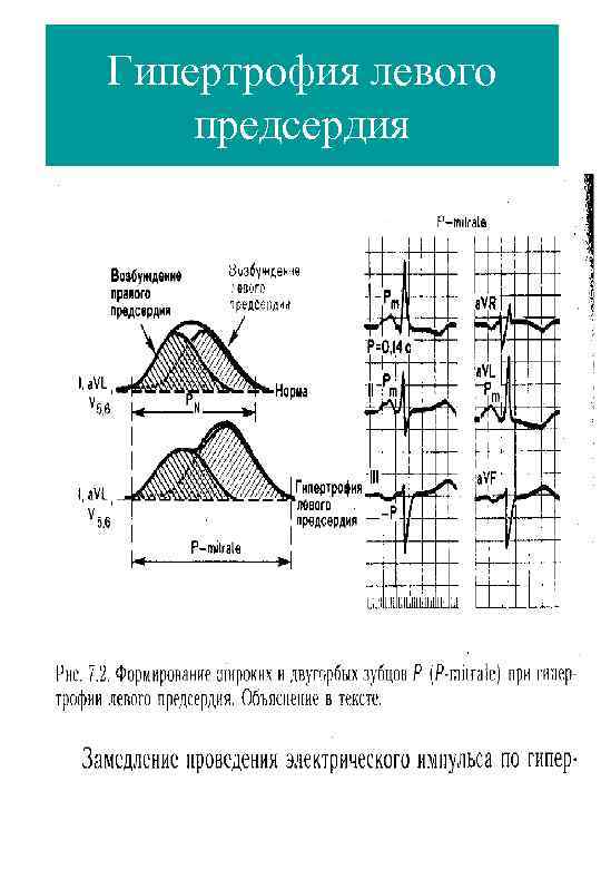 Гипертрофия левого предсердия 