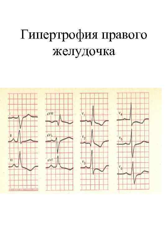 Гипертрофия правого желудочка 