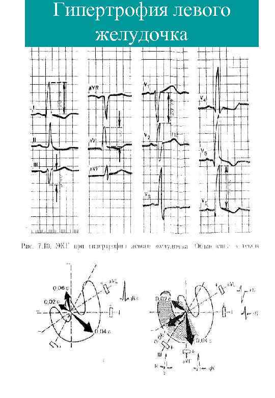 Гипертрофия левого желудочка 
