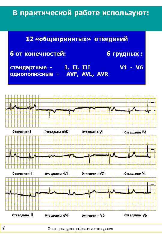 В практической работе используют: 12 «общепринятых» отведений 6 от конечностей: стандартные однополюсные - I