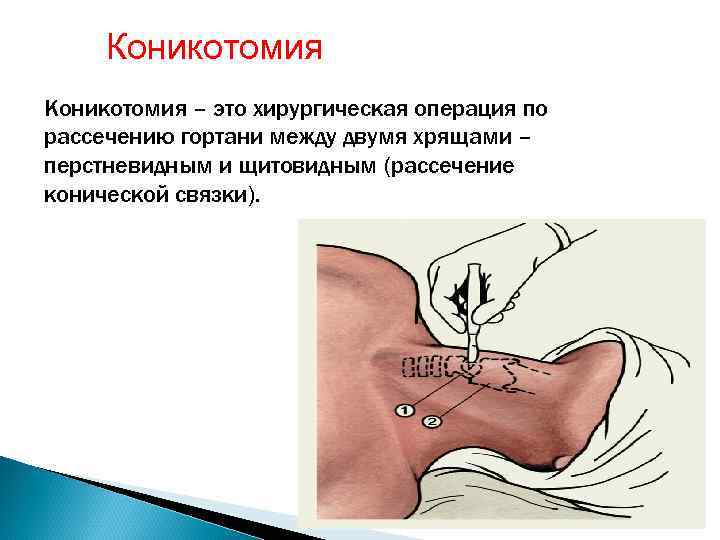 Коникотомия – это хирургическая операция по рассечению гортани между двумя хрящами – перстневидным и