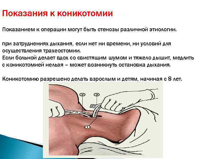 Показания к коникотомии Показанием к операции могут быть стенозы различной этиологии. при затруднениях дыхания,