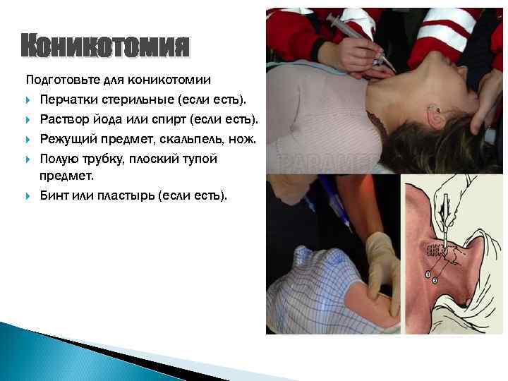 Коникотомия Подготовьте для коникотомии Перчатки стерильные (если есть). Раствор йода или спирт (если есть).
