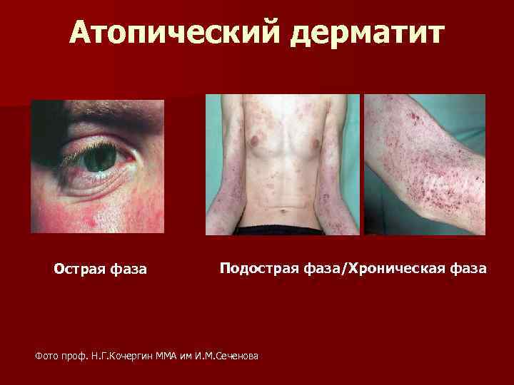 Атопический дерматит Острая фаза Подострая фаза/Хроническая фаза Фото проф. Н. Г. Кочергин ММА им