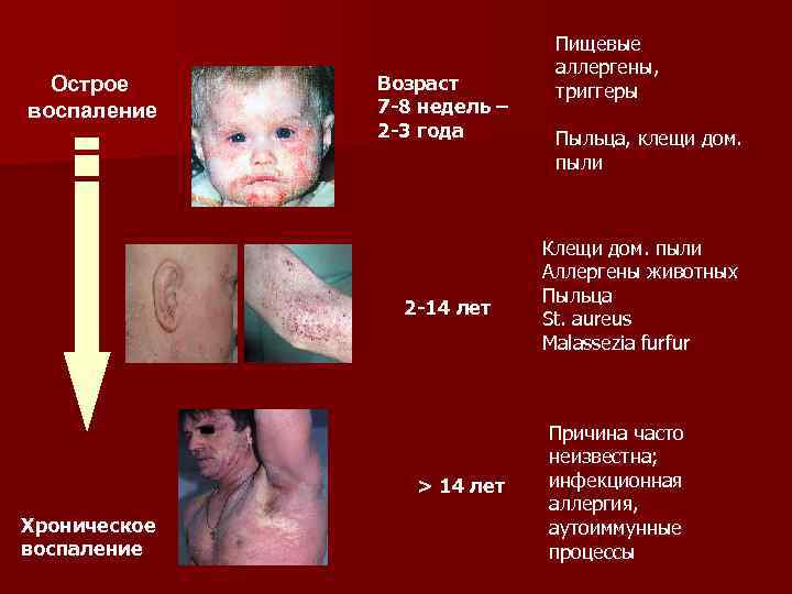 Острое воспаление Возраст 7 -8 недель – 2 -3 года 2 -14 лет >