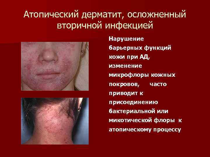 Атопический дерматит, осложненный вторичной инфекцией Нарушение барьерных функций кожи при АД, изменение микрофлоры кожных