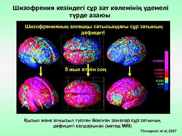 Шизофрения кезіндегі сұр зат көлемінің үдемелі түрде азаюы Шизофренияның алғашқы сатысындағы сұр затының дефициті