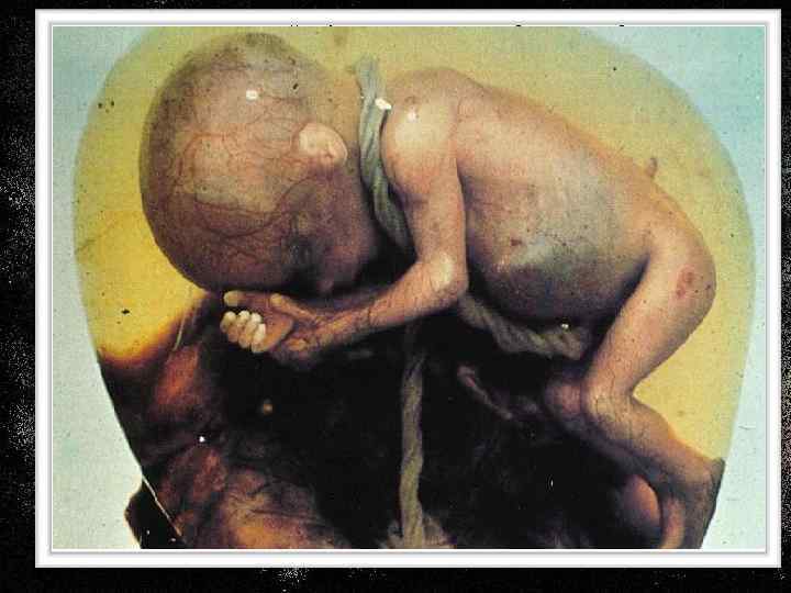 Как не рассматривай аборт, то его следствие одинаково с преступлением маньяков - психопатов 1.