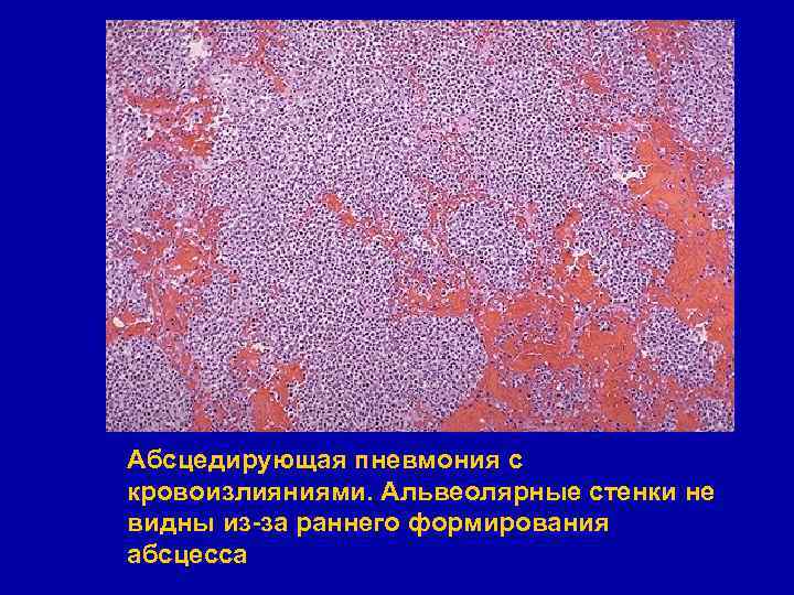 Абсцедирующая пневмония с кровоизлияниями. Альвеолярные стенки не видны из-за раннего формирования абсцесса 