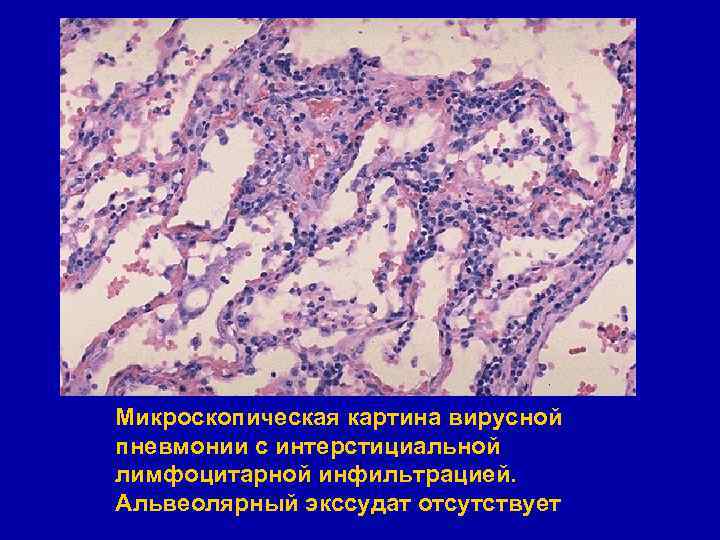 Микроскопическая картина вирусной пневмонии с интерстициальной лимфоцитарной инфильтрацией. Альвеолярный экссудат отсутствует 