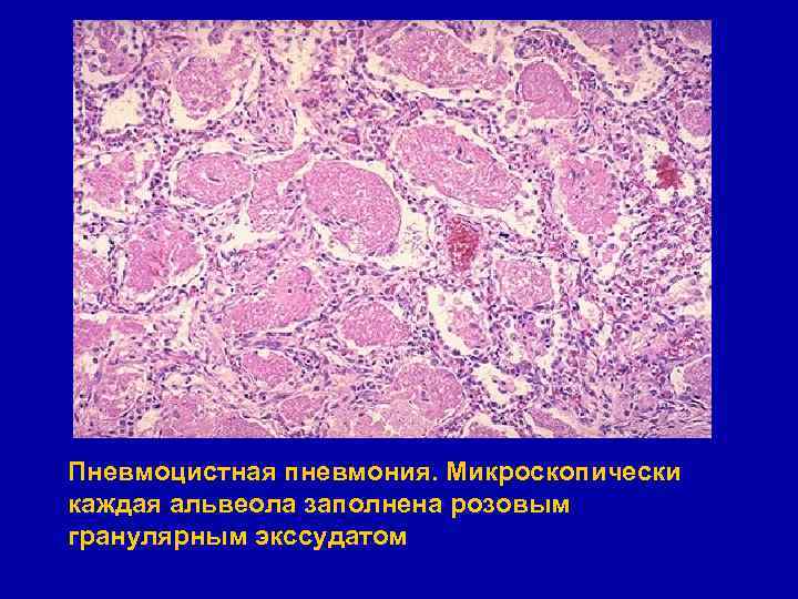 Пневмоцистная пневмония. Микроскопически каждая альвеола заполнена розовым гранулярным экссудатом 