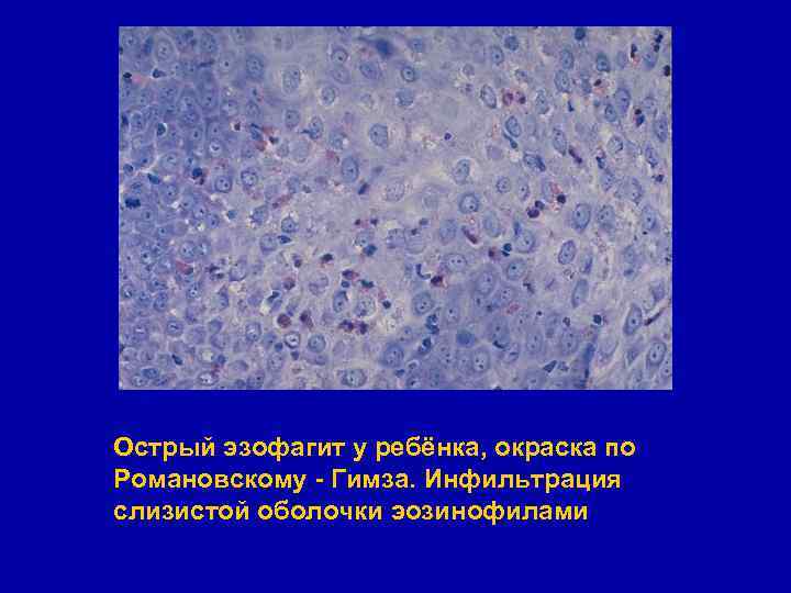 Острый эзофагит у ребёнка, окраска по Романовскому - Гимза. Инфильтрация слизистой оболочки эозинофилами 