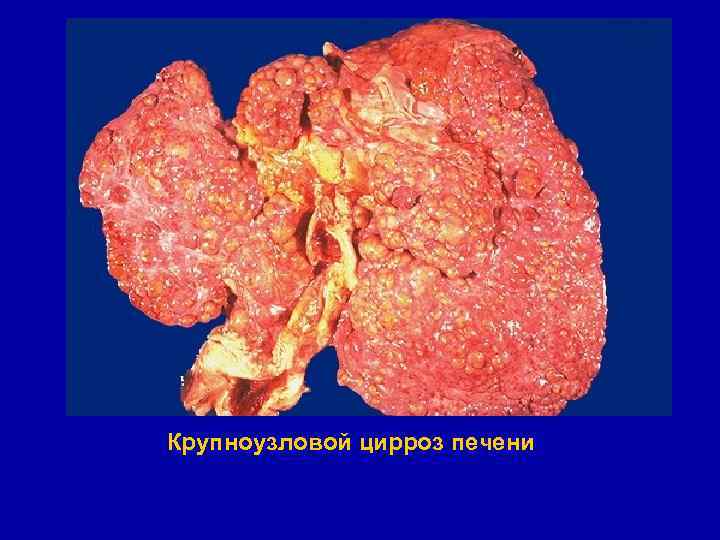 Крупноузловой цирроз печени 