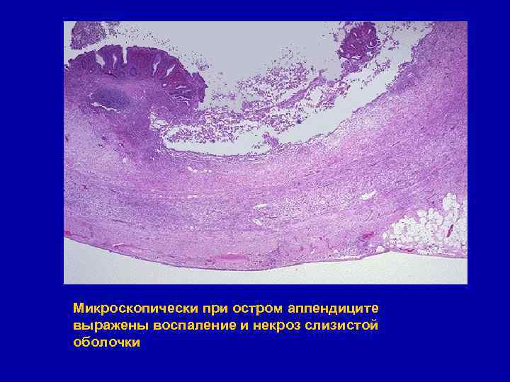 Флегмонозный аппендицит микропрепарат рисунок