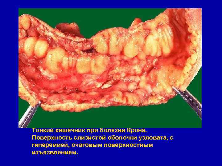 Тонкий кишечник при болезни Крона. Поверхность слизистой оболочки узловата, с гиперемией, очаговым поверхностным изъязвлением.