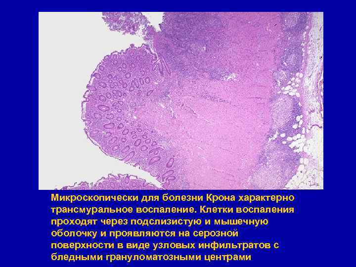 Микроскопически для болезни Крона характерно трансмуральное воспаление. Клетки воспаления проходят через подслизистую и мышечную