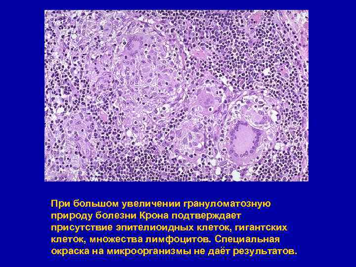 При большом увеличении грануломатозную природу болезни Крона подтверждает присутствие эпителиоидных клеток, гигантских клеток, множества