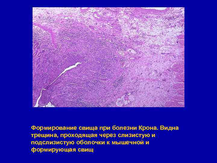Формирование свища при болезни Крона. Видна трещина, проходящая через слизистую и подслизистую оболочки к