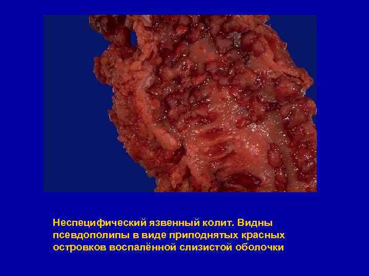 Неспецифический язвенный колит. Видны псевдополипы в виде приподнятых красных островков воспалённой слизистой оболочки 