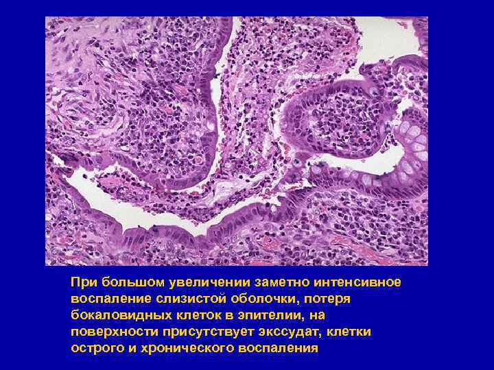 При большом увеличении заметно интенсивное воспаление слизистой оболочки, потеря бокаловидных клеток в эпителии, на