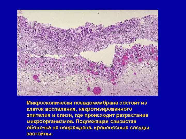 Микроскопически псевдомембрана состоит из клеток воспаления, некротизированного эпителия и слизи, где происходит разрастание микроорганизмов.