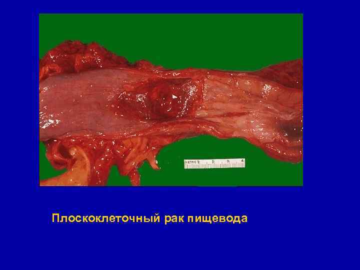 Плоскоклеточный рак пищевода 