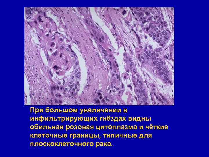 При большом увеличении в инфильтрирующих гнёздах видны обильная розовая цитоплазма и чёткие клеточные границы,