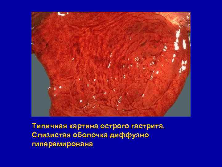 Типичная картина острого гастрита. Слизистая оболочка диффузно гиперемирована 