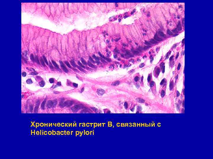 Хронический гастрит В, связанный с Helicobacter pylori 