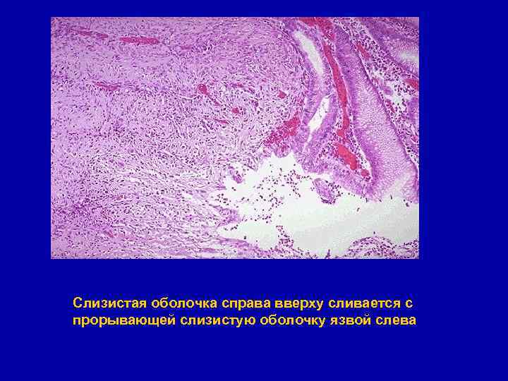 Слизистая оболочка справа вверху сливается с прорывающей слизистую оболочку язвой слева 