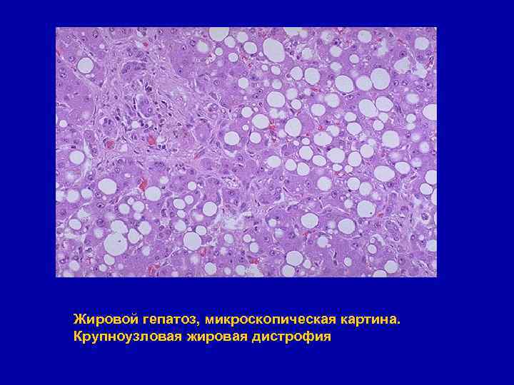 Жировой гепатоз, микроскопическая картина. Крупноузловая жировая дистрофия 
