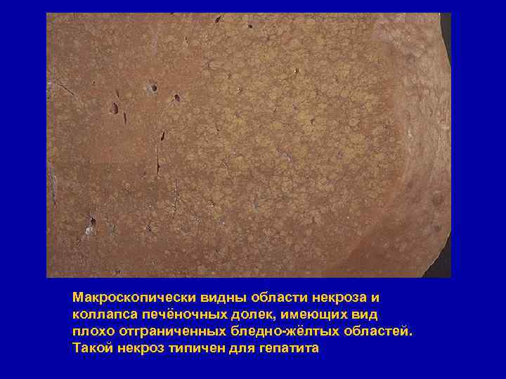 Макроскопически видны области некроза и коллапса печёночных долек, имеющих вид плохо отграниченных бледно-жёлтых областей.