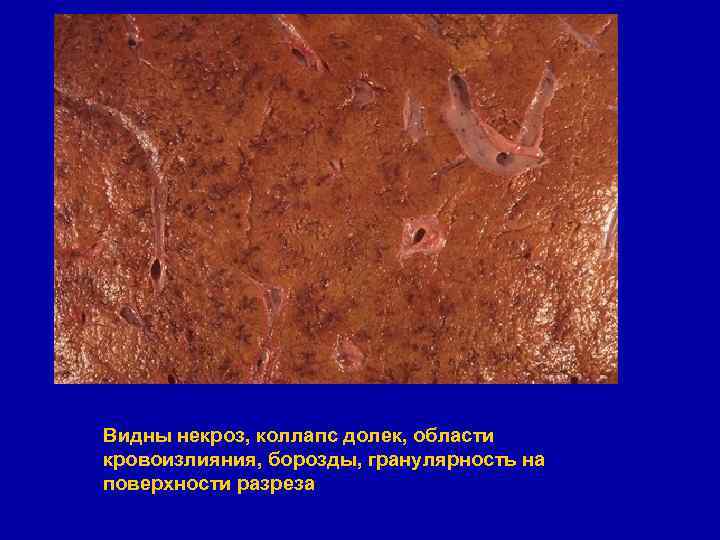 Видны некроз, коллапс долек, области кровоизлияния, борозды, гранулярность на поверхности разреза 