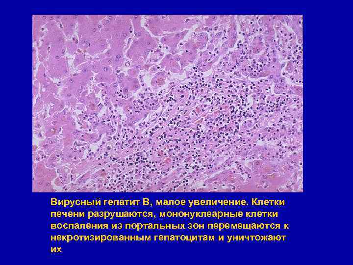 Вирусный гепатит В, малое увеличение. Клетки печени разрушаются, мононуклеарные клетки воспаления из портальных зон