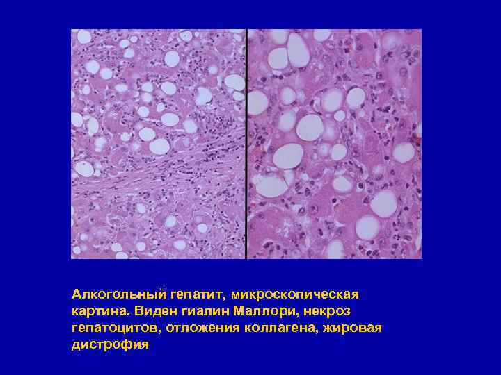 Гистологическая картина алкогольного гепатита