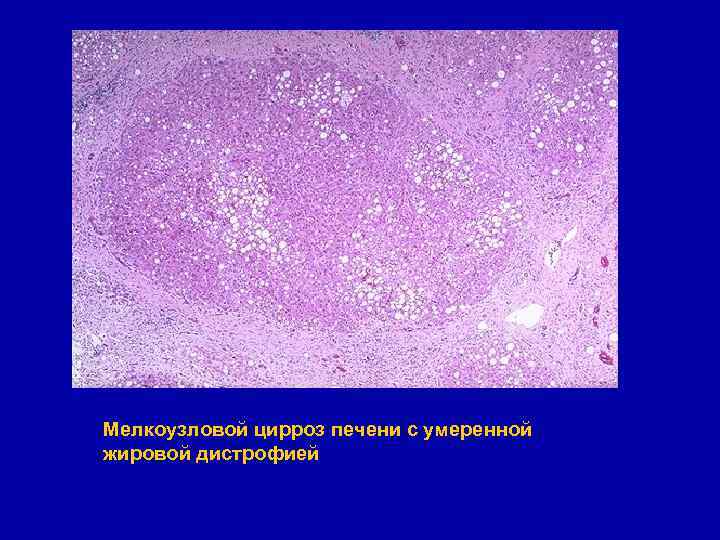 Мелкоузловой цирроз печени с умеренной жировой дистрофией 