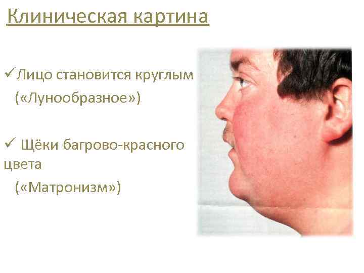 Клиническая картина üЛицо становится круглым ( «Лунообразное» ) ü Щёки багрово-красного цвета ( «Матронизм»