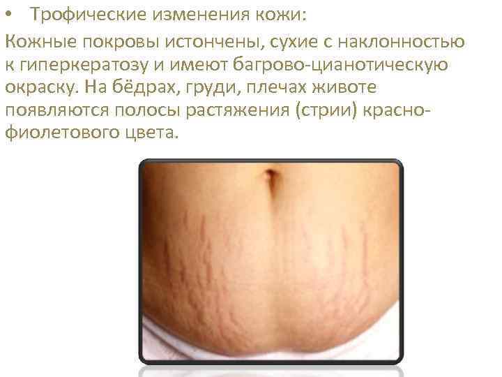  • Трофические изменения кожи: Кожные покровы истончены, сухие с наклонностью к гиперкератозу и