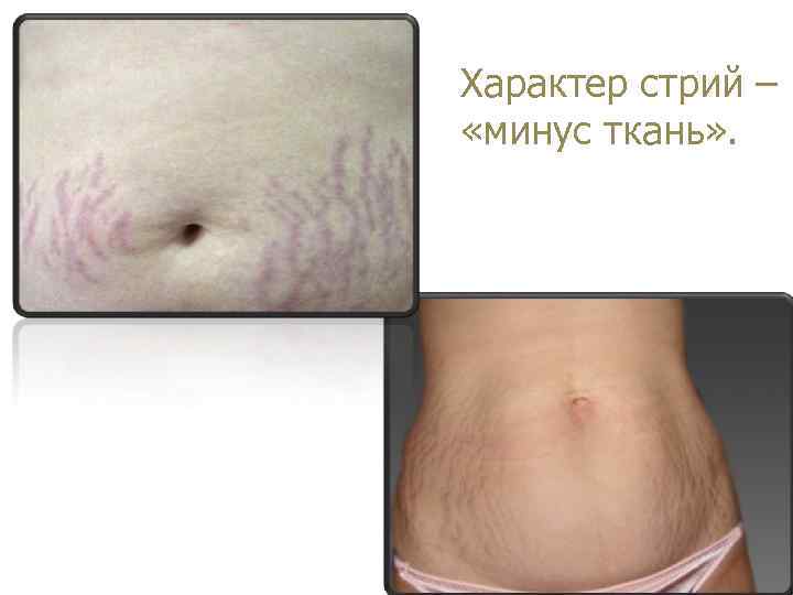 Характер стрий – «минус ткань» . 