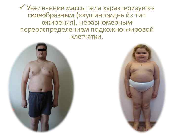 ü Увеличение массы тела характеризуется своеобразным ( «кушингоидный» тип ожирения), неравномерным перераспределением подкожно-жировой клетчатки.