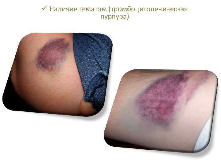 ü Наличие гематом (тромбоцитопеническая пурпура) 